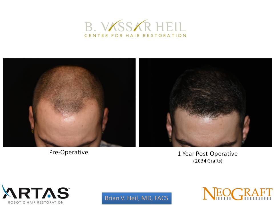 Hair Restoration Before and After | Premier Plastic Surgery