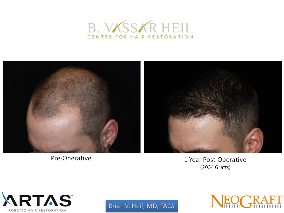 Hair Restoration Before and After | Premier Plastic Surgery