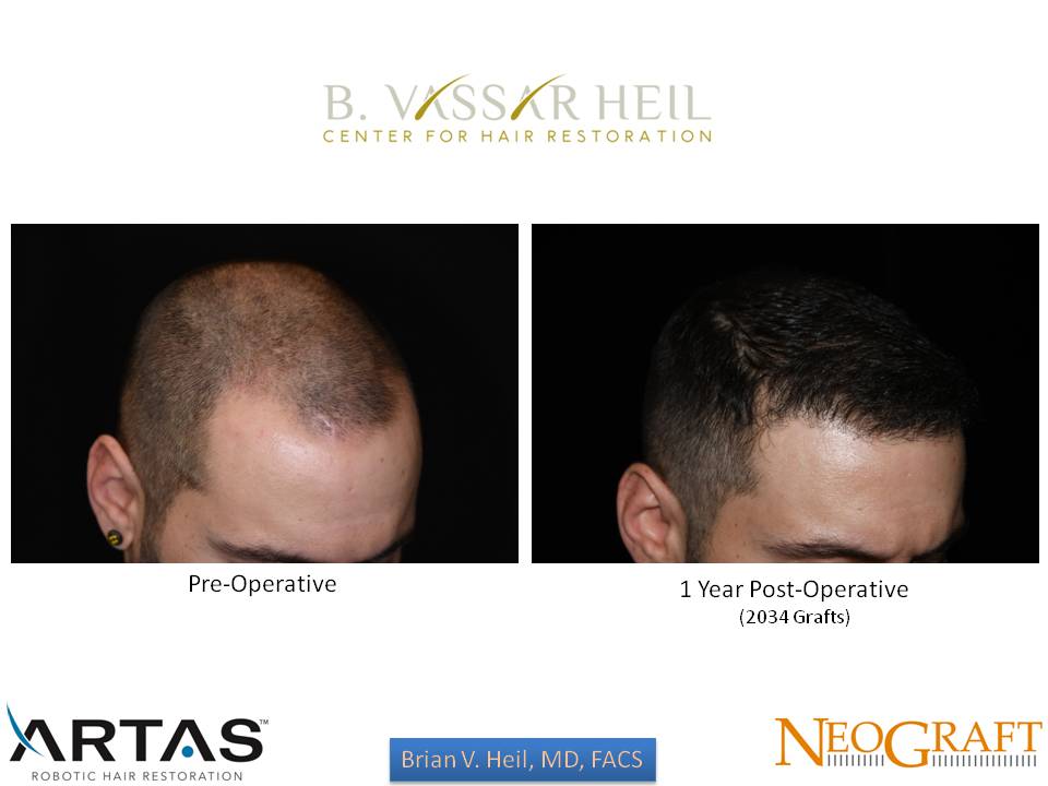 Hair Restoration Before and After | Premier Plastic Surgery