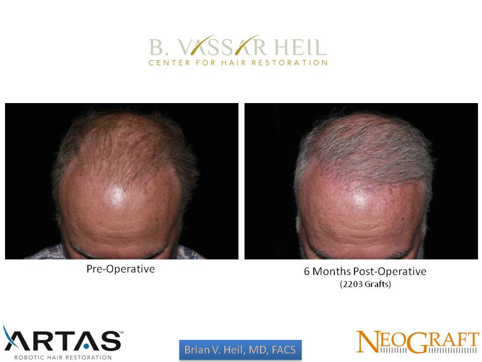 Hair Restoration Before and After | Premier Plastic Surgery