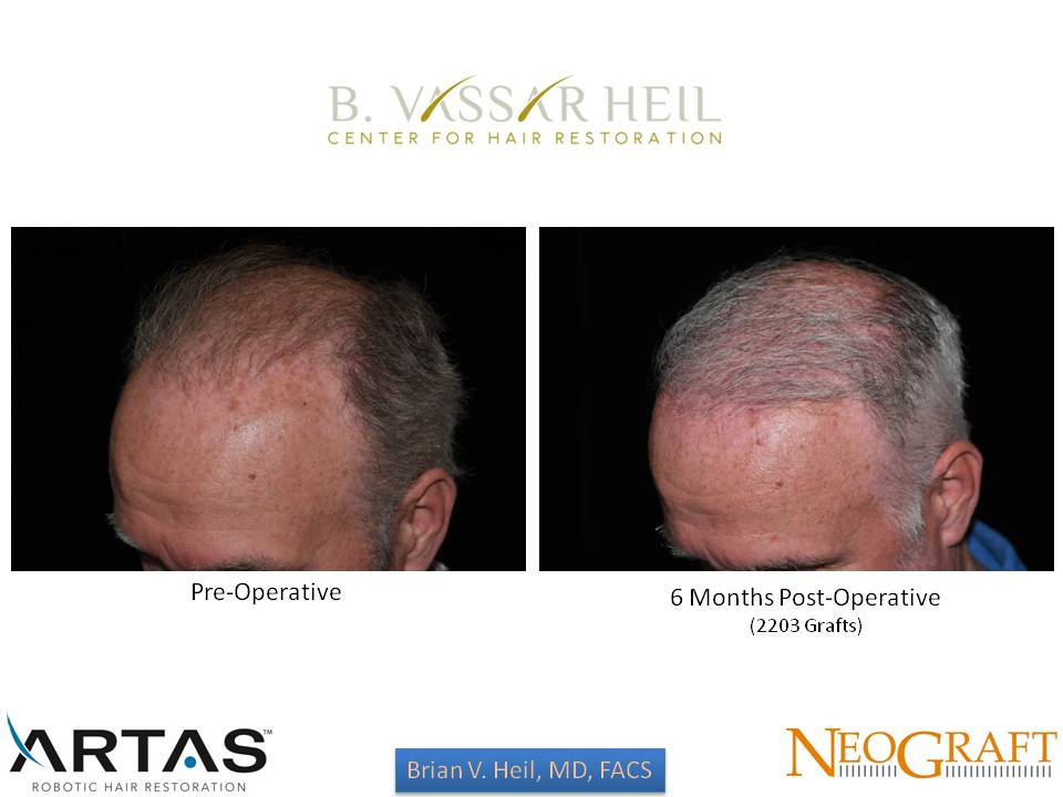 Hair Restoration Before and After | Premier Plastic Surgery