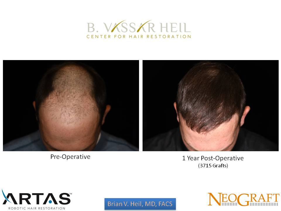 Hair Restoration Before and After | Premier Plastic Surgery