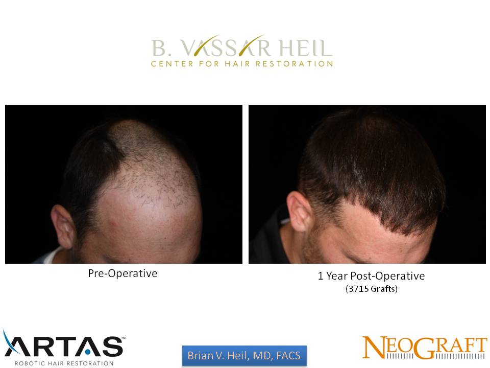 Hair Restoration Before and After | Premier Plastic Surgery