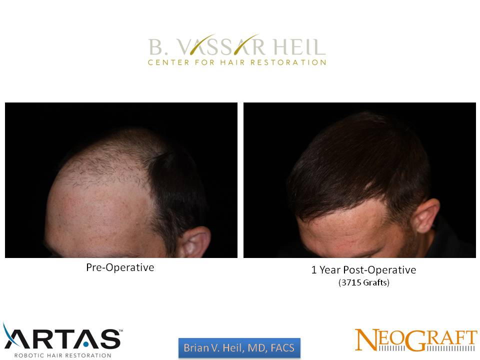 Hair Restoration Before and After | Premier Plastic Surgery