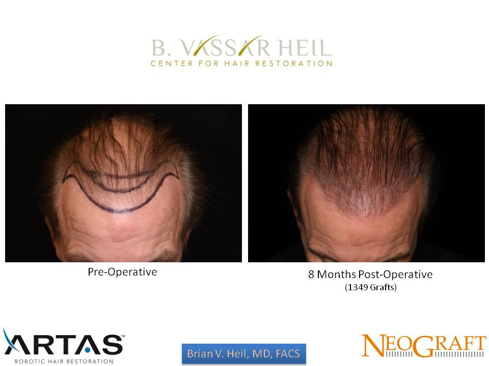 Hair Restoration Before and After | Premier Plastic Surgery