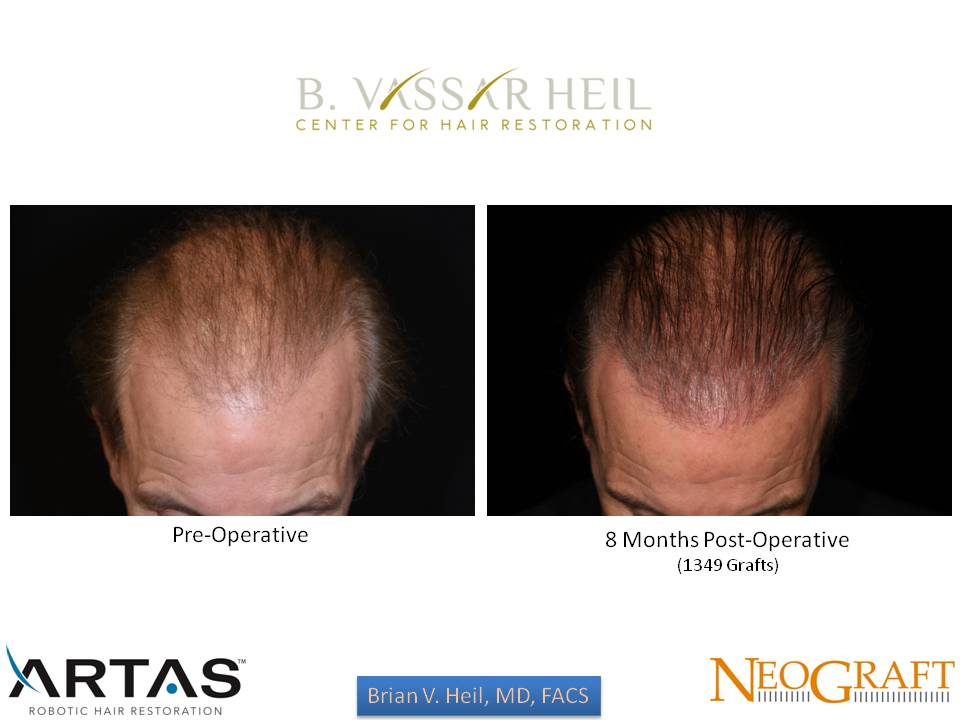 Hair Restoration Before and After | Premier Plastic Surgery