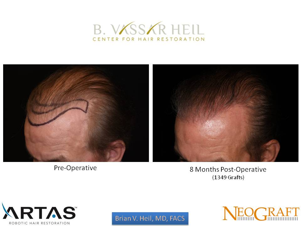 Hair Restoration Before and After | Premier Plastic Surgery