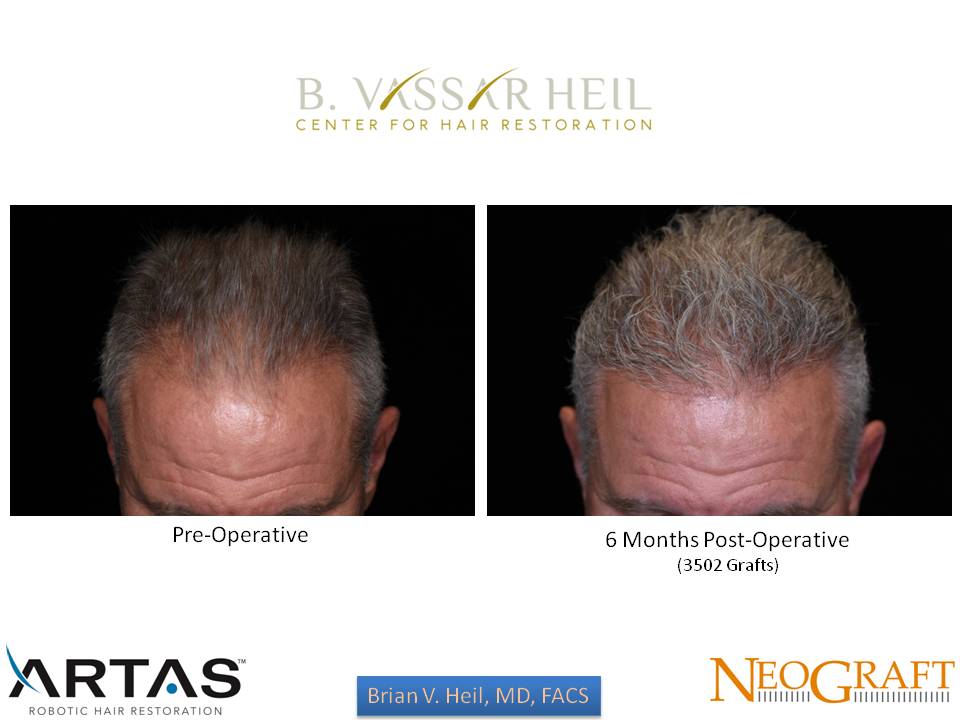 Hair Restoration Before and After | Premier Plastic Surgery