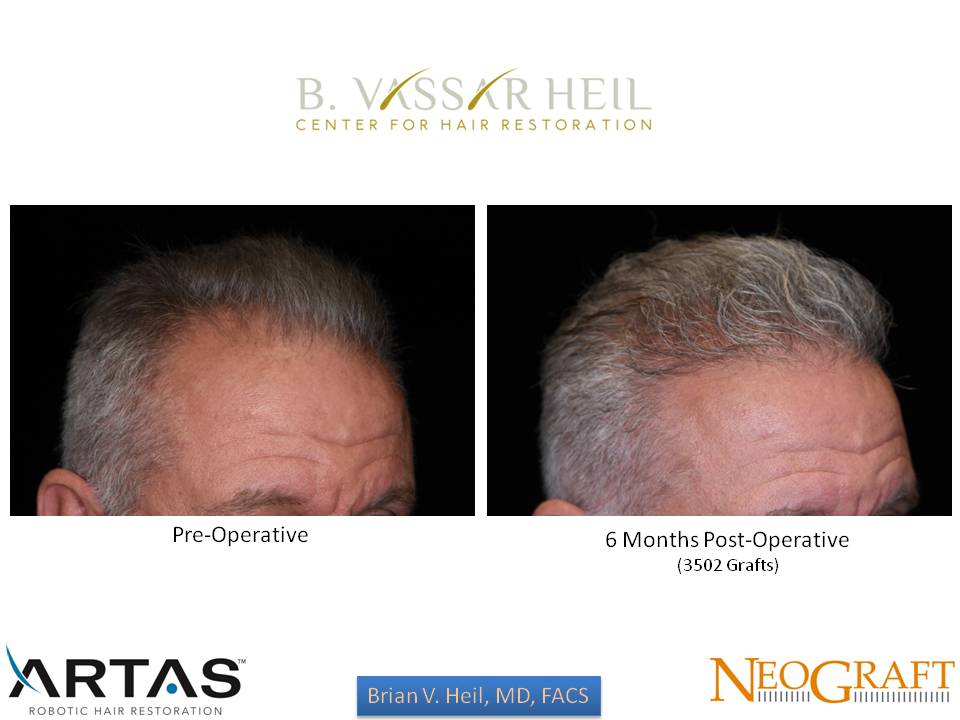 Hair Restoration Before and After | Premier Plastic Surgery