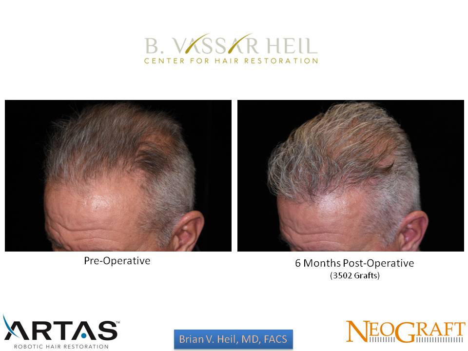 Hair Restoration Before and After | Premier Plastic Surgery