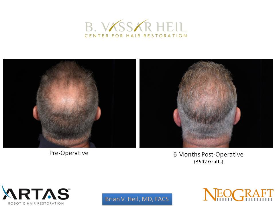 Hair Restoration Before and After | Premier Plastic Surgery