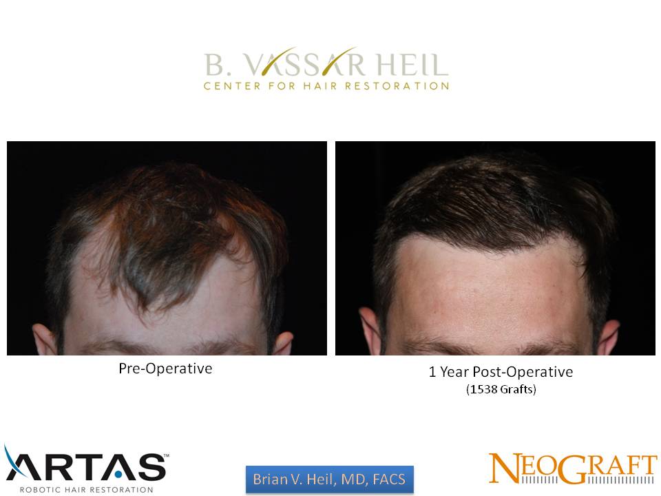 Hair Restoration Before and After | Premier Plastic Surgery