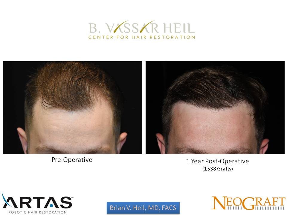 Hair Restoration Before and After | Premier Plastic Surgery