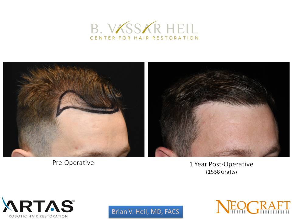 Hair Restoration Before and After | Premier Plastic Surgery