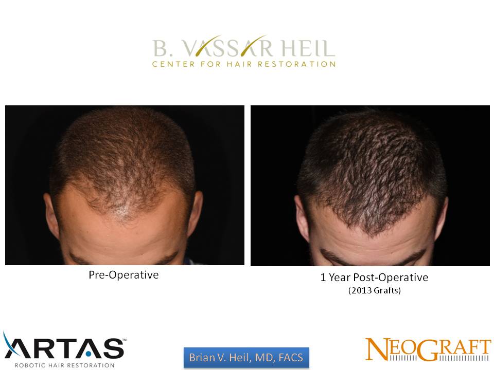 Hair Restoration Before and After | Premier Plastic Surgery