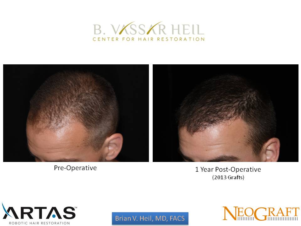 Hair Restoration Before and After | Premier Plastic Surgery