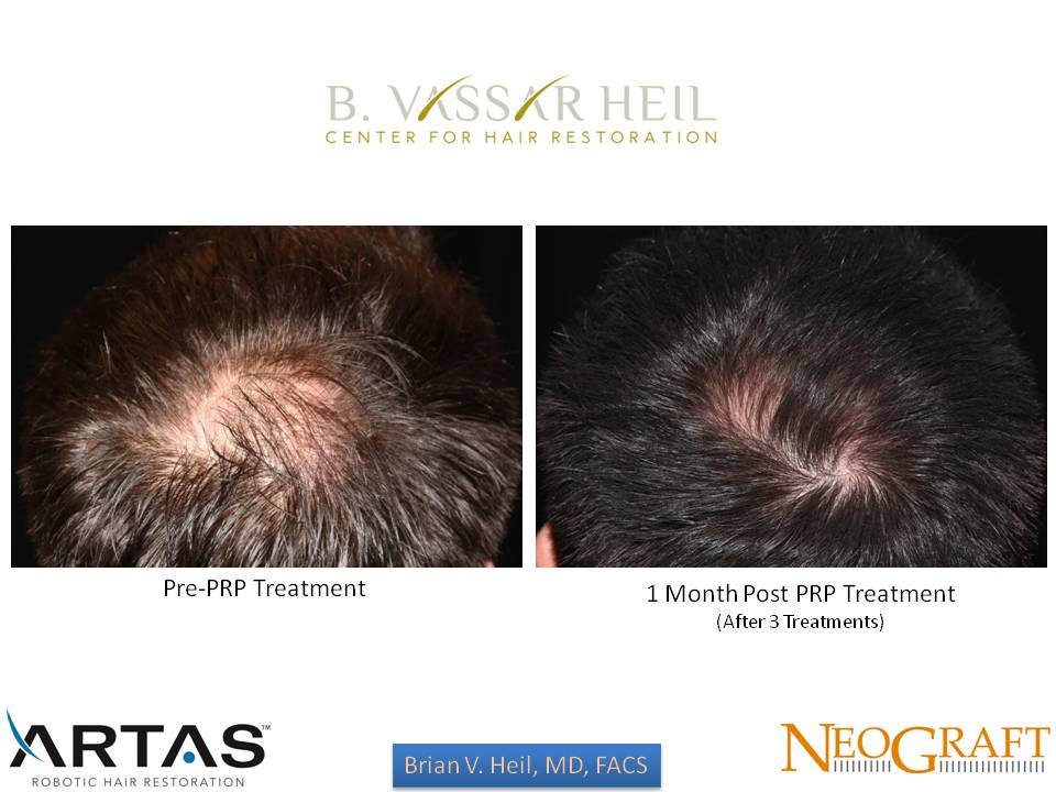 Hair Restoration Before and After | Premier Plastic Surgery