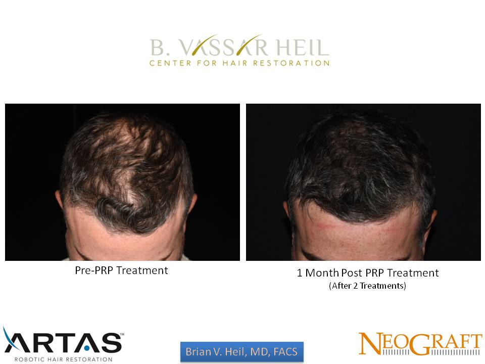 Hair Restoration Before and After | Premier Plastic Surgery