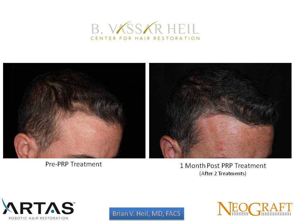 Hair Restoration Before and After | Premier Plastic Surgery