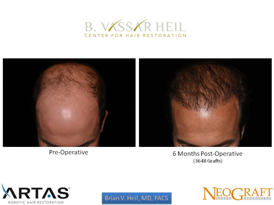 Hair Restoration Before and After | Premier Plastic Surgery