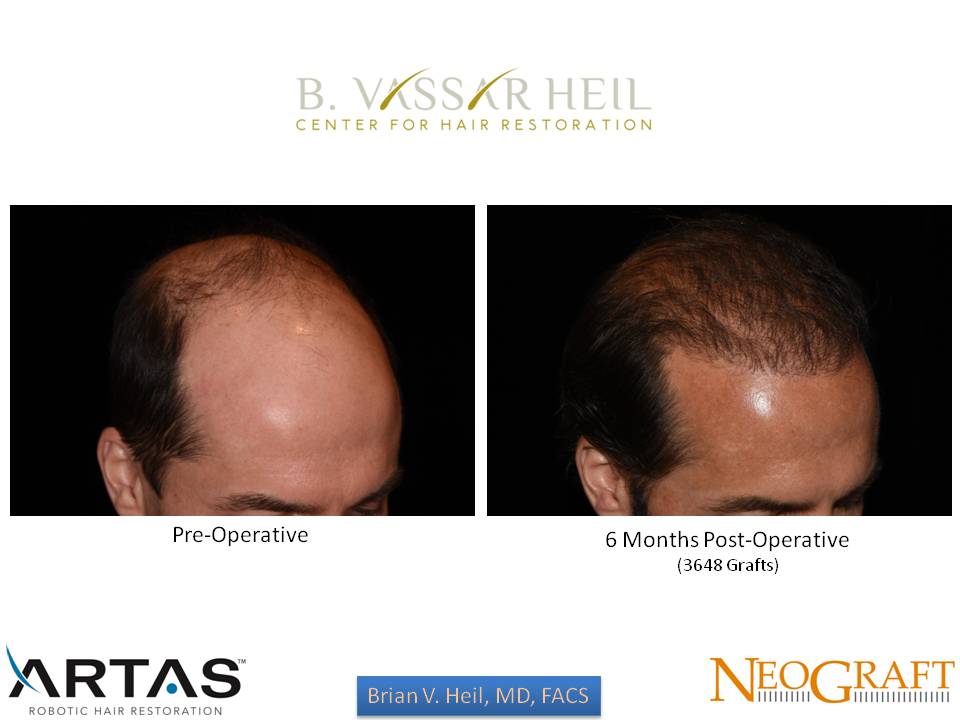 Hair Restoration Before and After | Premier Plastic Surgery