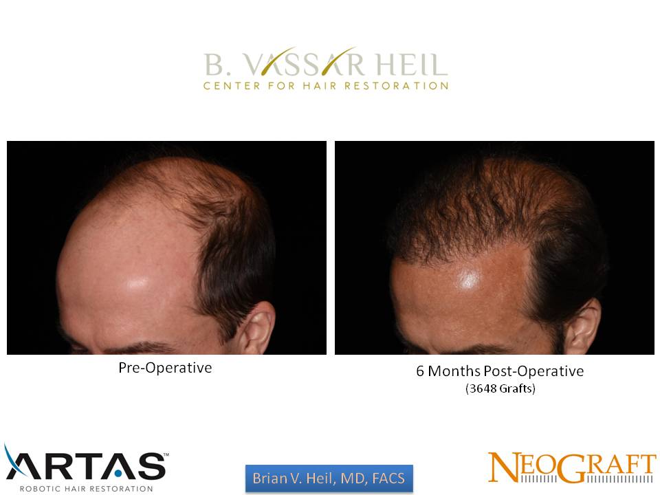 Hair Restoration Before and After | Premier Plastic Surgery