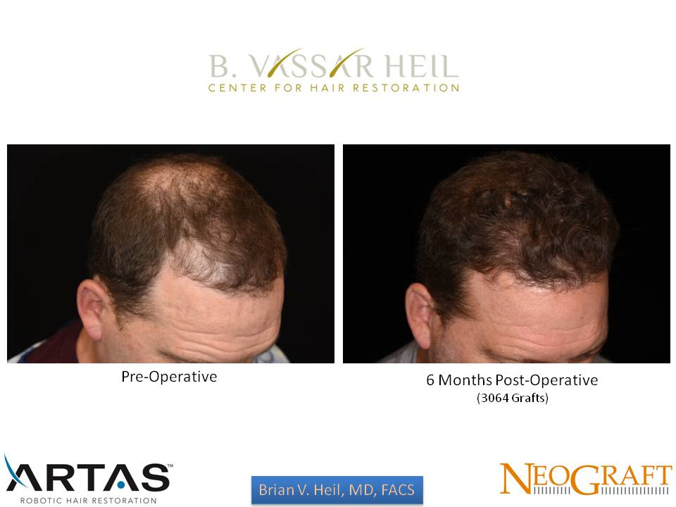 Hair Restoration Before and After | Premier Plastic Surgery