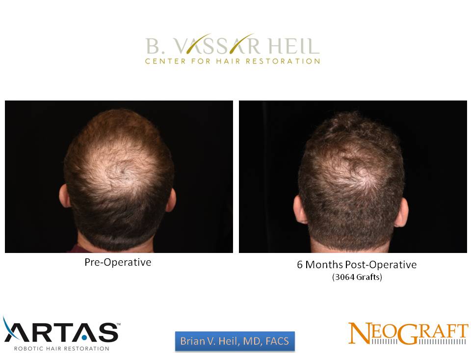 Hair Restoration Before and After | Premier Plastic Surgery