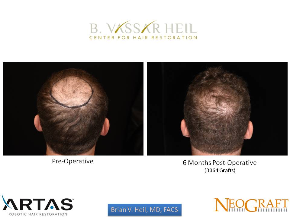 Hair Restoration Before and After | Premier Plastic Surgery