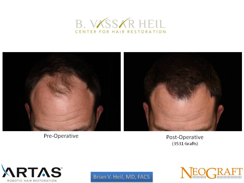 Hair Restoration Before and After | Premier Plastic Surgery