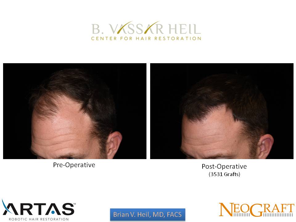 Hair Restoration Before and After | Premier Plastic Surgery