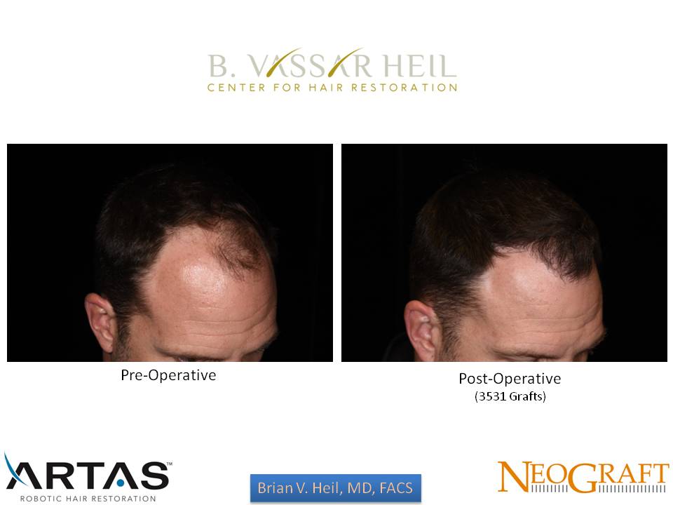 Hair Restoration Before and After | Premier Plastic Surgery