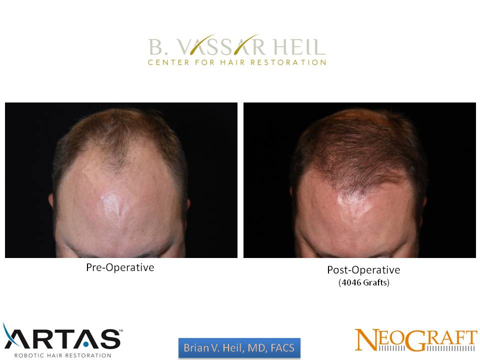 Hair Restoration Before and After | Premier Plastic Surgery