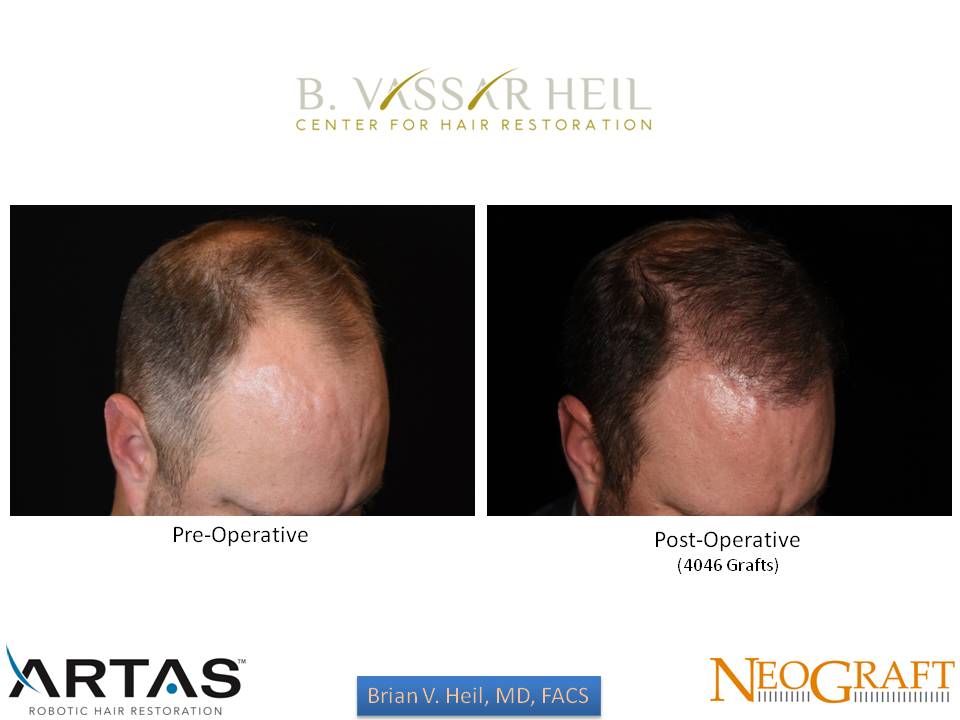 Hair Restoration Before and After | Premier Plastic Surgery