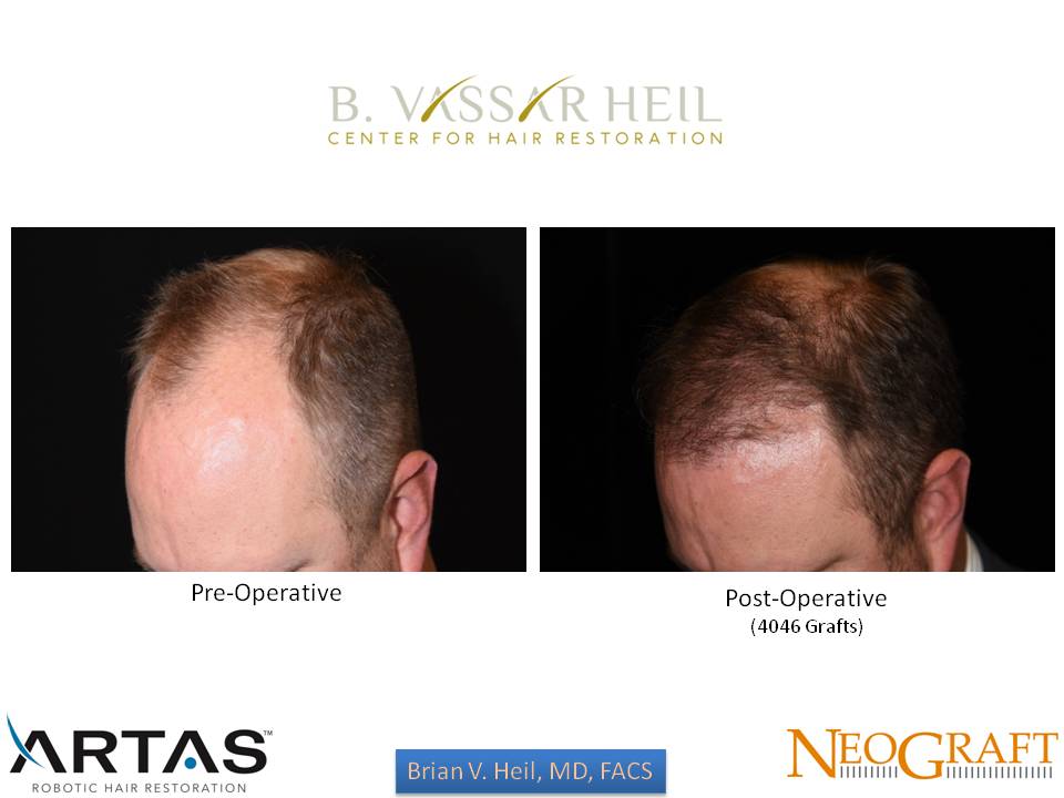 Hair Restoration Before and After | Premier Plastic Surgery