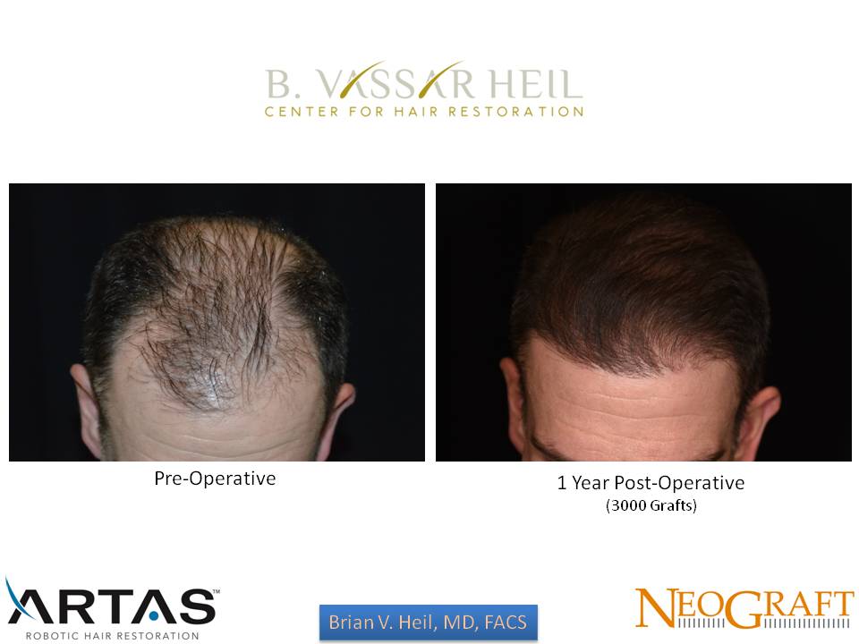 Hair Restoration Before and After | Premier Plastic Surgery