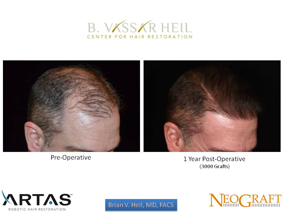 Hair Restoration Before and After | Premier Plastic Surgery