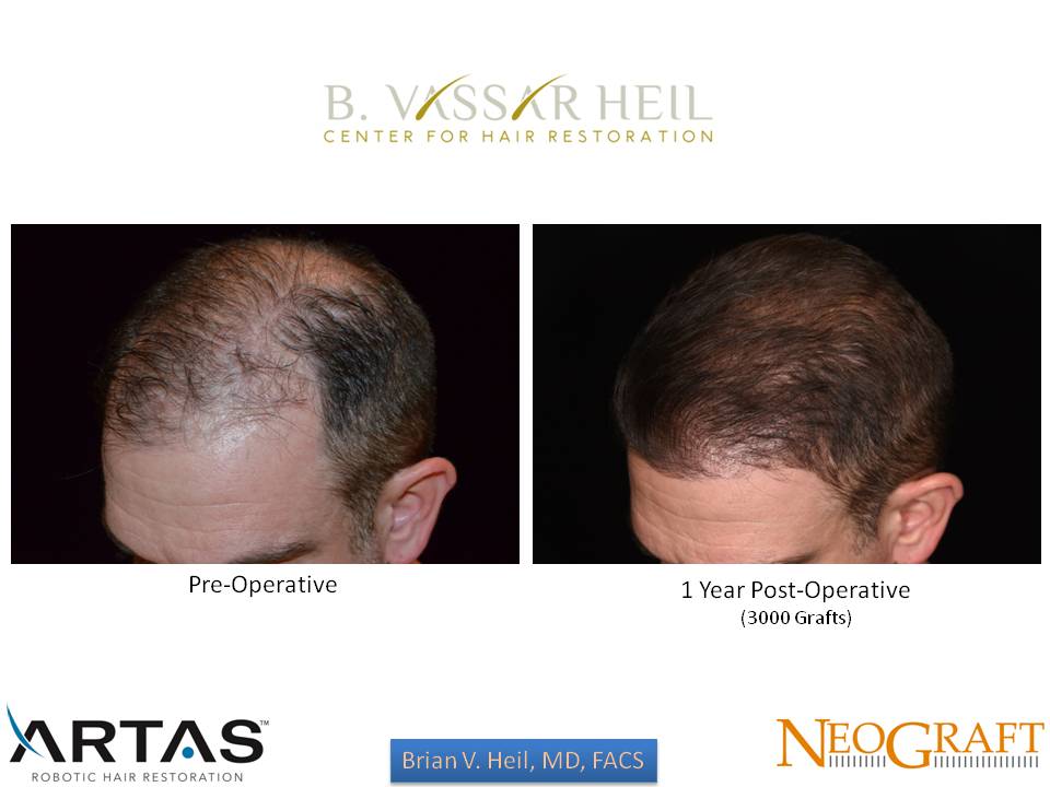 Hair Restoration Before and After | Premier Plastic Surgery