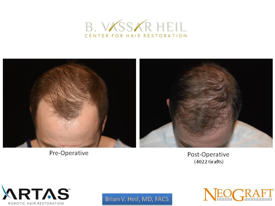 Hair Restoration Before and After | Premier Plastic Surgery