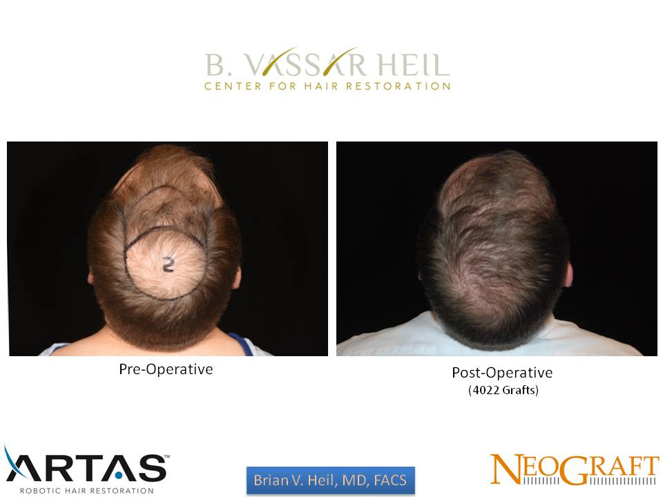 Hair Restoration Before and After | Premier Plastic Surgery