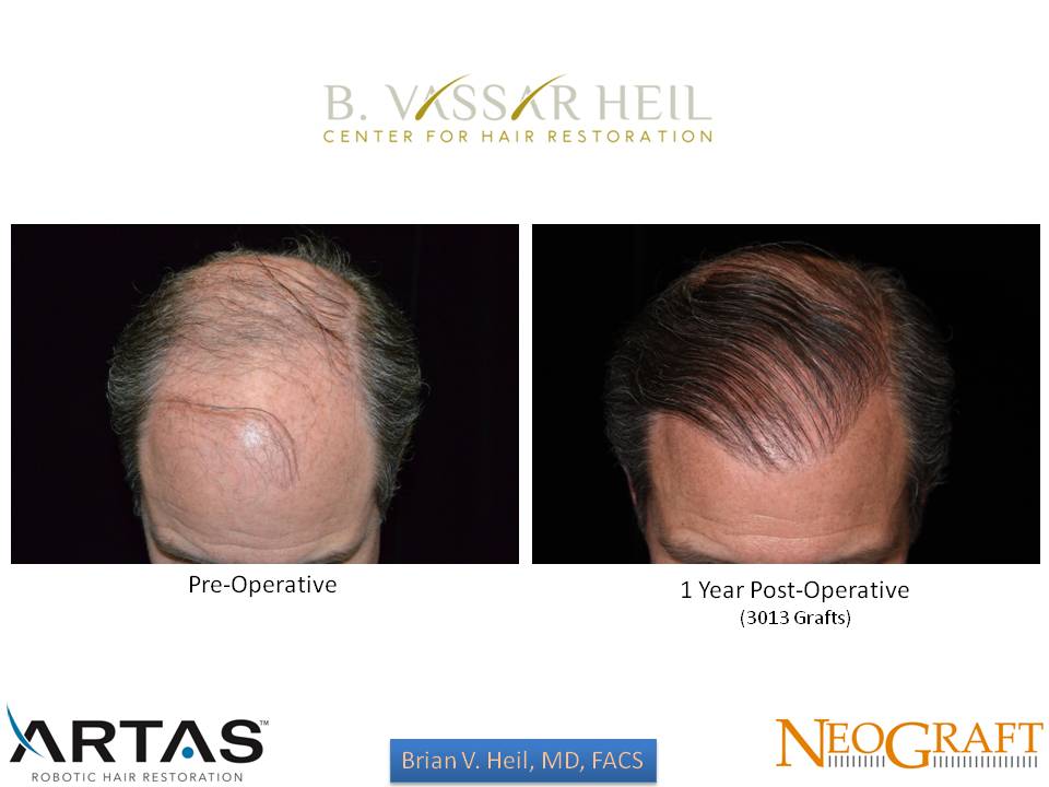 Hair Restoration Before and After | Premier Plastic Surgery