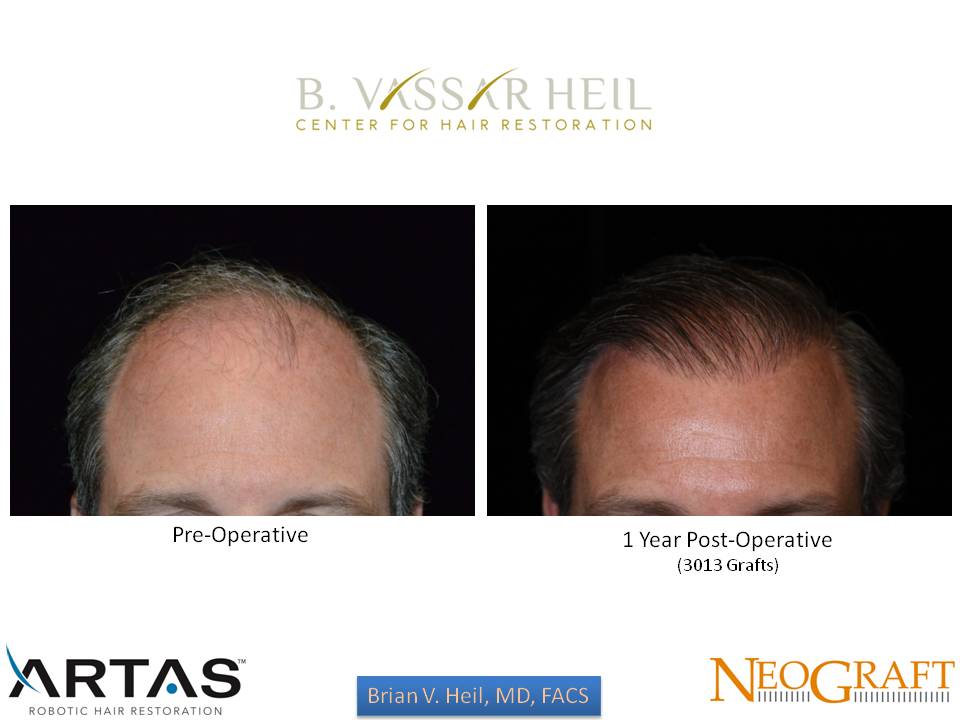 Hair Restoration Before and After | Premier Plastic Surgery