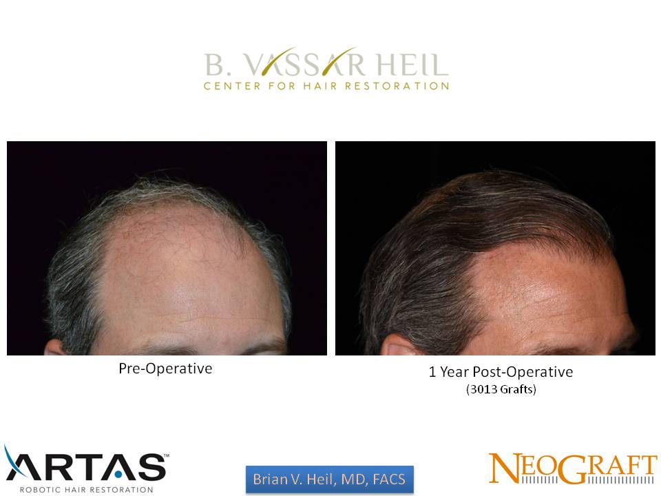 Hair Restoration Before and After | Premier Plastic Surgery