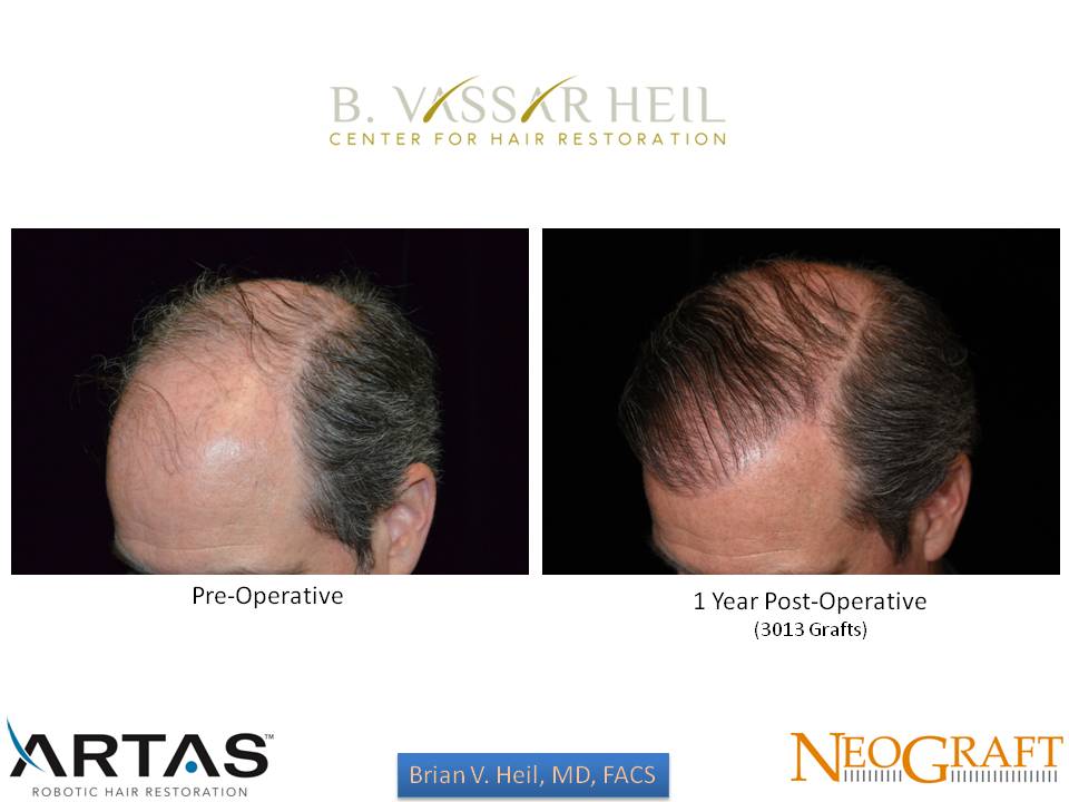 Hair Restoration Before and After | Premier Plastic Surgery