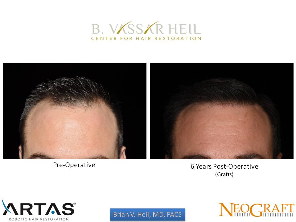 Hair Restoration Before and After | Premier Plastic Surgery