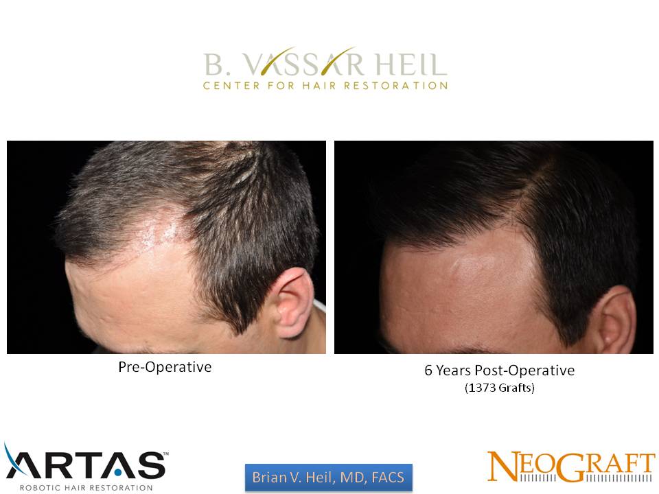 Hair Restoration Before and After | Premier Plastic Surgery