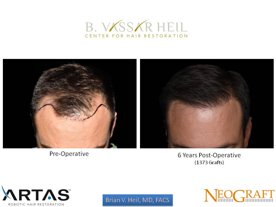 Hair Restoration Before and After | Premier Plastic Surgery