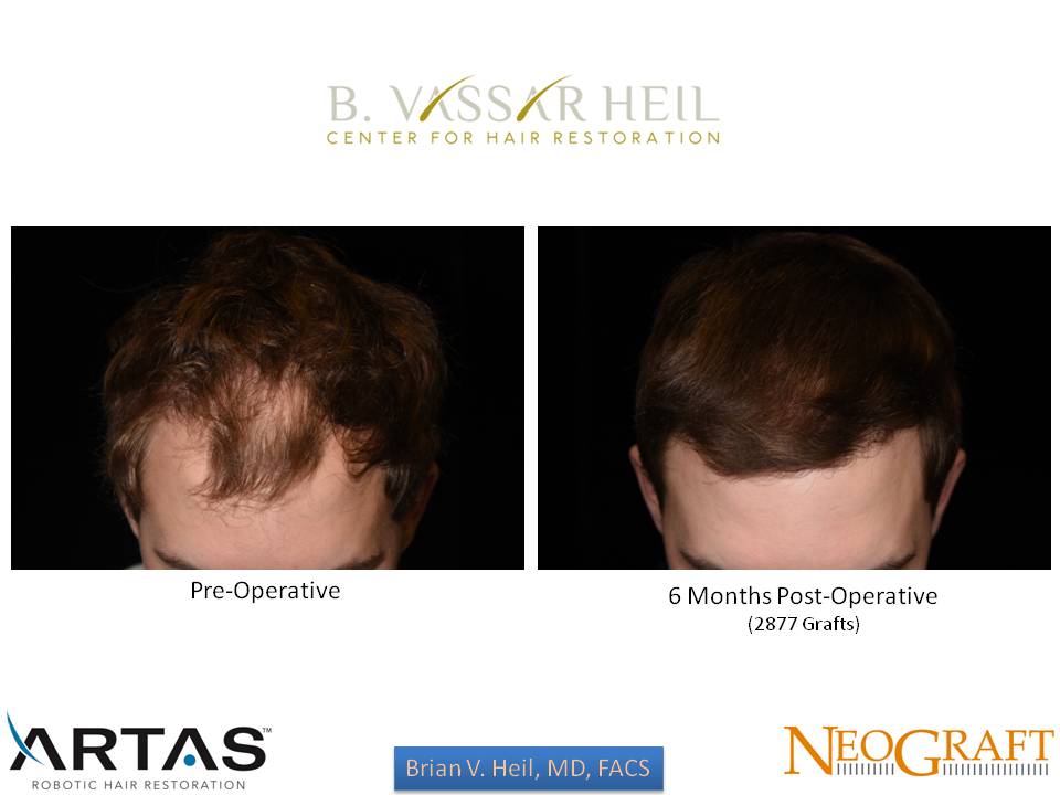 Hair Restoration Before and After | Premier Plastic Surgery