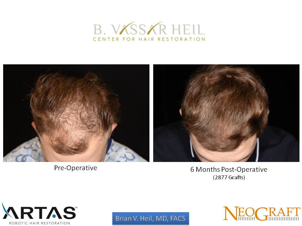 Hair Restoration Before and After | Premier Plastic Surgery