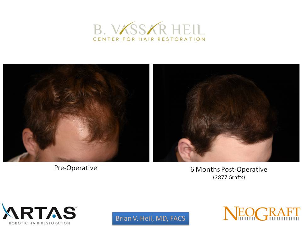 Hair Restoration Before and After | Premier Plastic Surgery